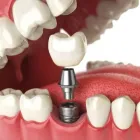 Business 8 image CROWN DENTAL DUBLIN Dentists in Dublin D